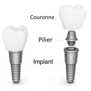 prix implant dentaire lyon
