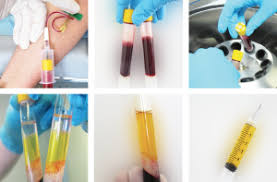 Complications possibles des injections du PRP injection prp tunisie