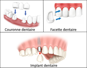 facette dentaire lyon