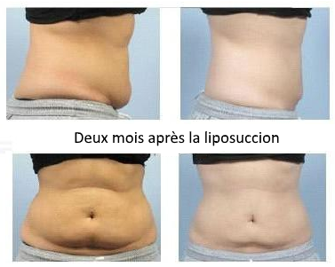 liposuccion lyon