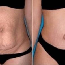 Comment se préparer avant une abdominoplastie ? Comment se préparer avant une abdominoplastie ?