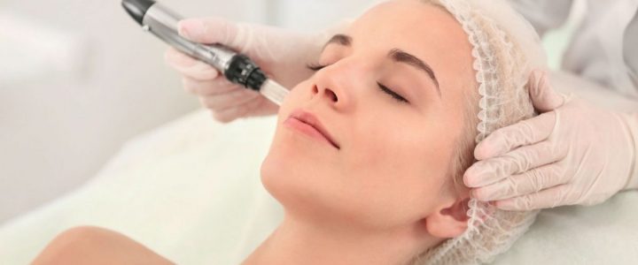 Micro needling hollywood peel