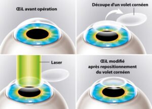 correction myopie laser lyon
