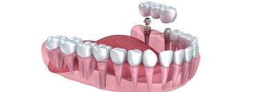 Quand envisager l’implantologie dentaire ?