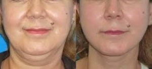 lifting visage sans chirurgie