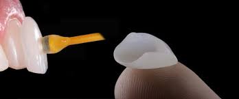 Facette veneer Hongrie facette veneer hongrie