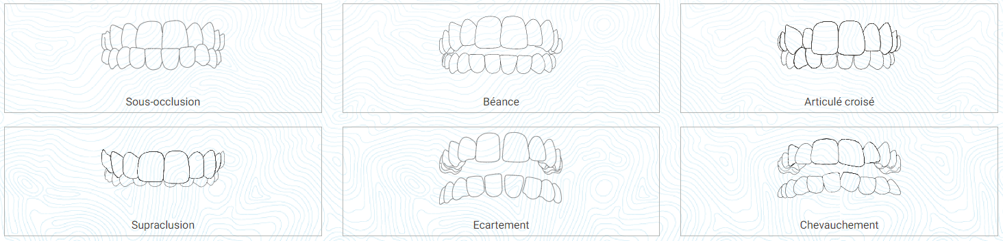 invisalign lyon