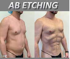 abdominal etching