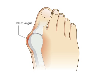 Hallux valgus : Comment cela se produit-il et que pouvez-vous faire ? Hallux Valgus