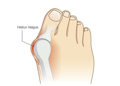 Hallux Valgus