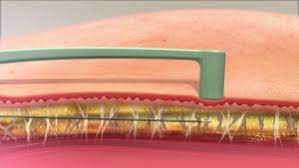 bodytite liposuccion radiofrequence