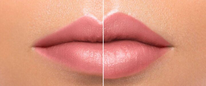 FAQ sur la chirurgie esthétique des lèvres