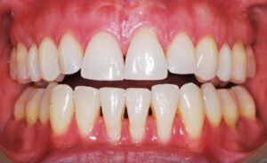 recession gingivale