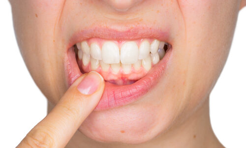 recession gingivale