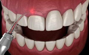 gingivectomie laser