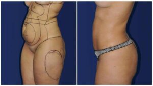 Liposuccion haute définition