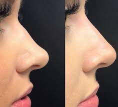 Refaire un nez français sans chirurgie avec Rhinofiller