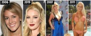 Chirurgie esthétique de Heidi Montag