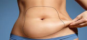 Abdominoplastie classique vs High Definition Abdo : quelle intervention choisir ?