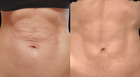 Argo Plasma, BodyTite et J-Plasma : trois technologies innovantes pour raffermir la peau sans chirurgie