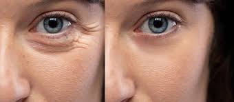 Rajeunir le regard : solutions pour cernes, ridules et paupières tombantes rajeunir regard