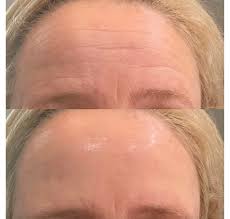 wrinkle relaxer