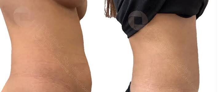 Comment retendre la peau relâchée sans lifting classique ? solutions pour raffermir la peau relâchée